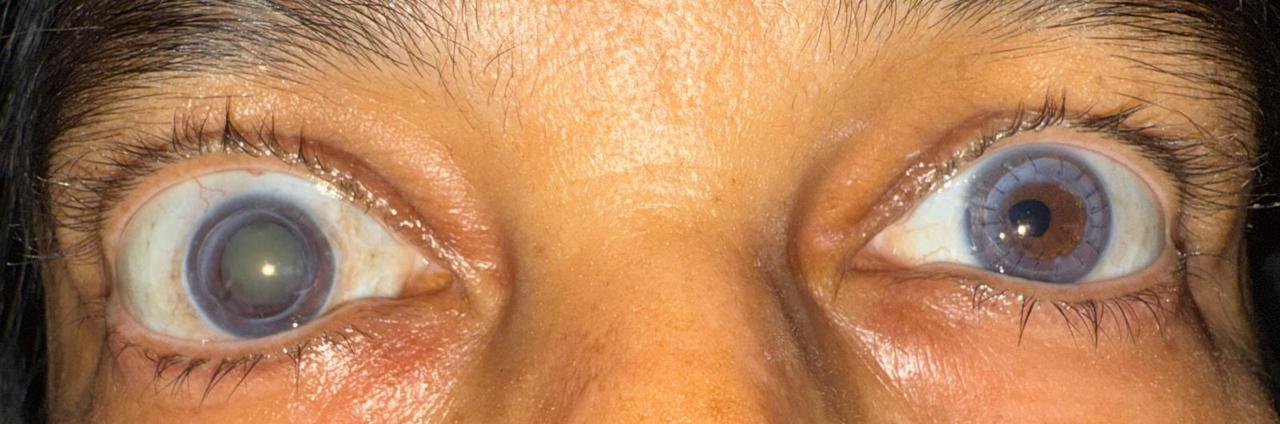 Before Treatment