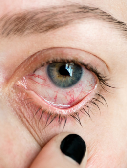UVEA OCULAR INFLAMATORY
